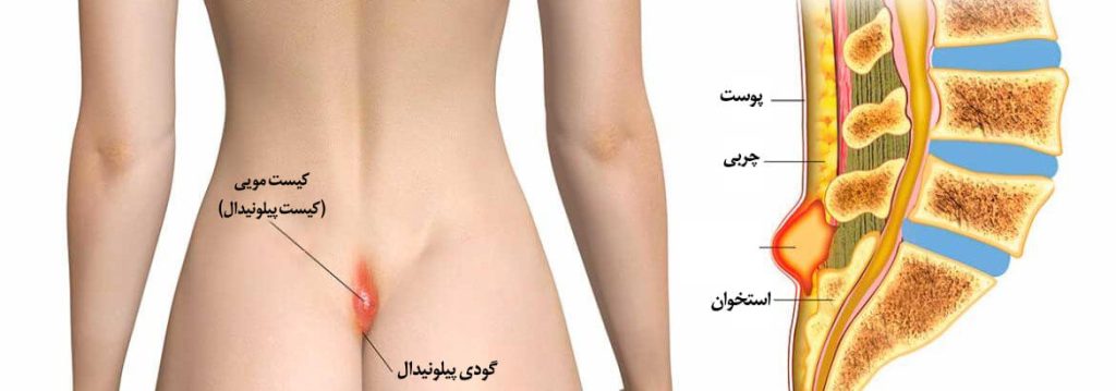 عکس کیست مویی در مشهد