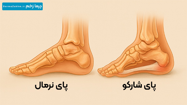 تفاوت پای شارکو با پای نرمال